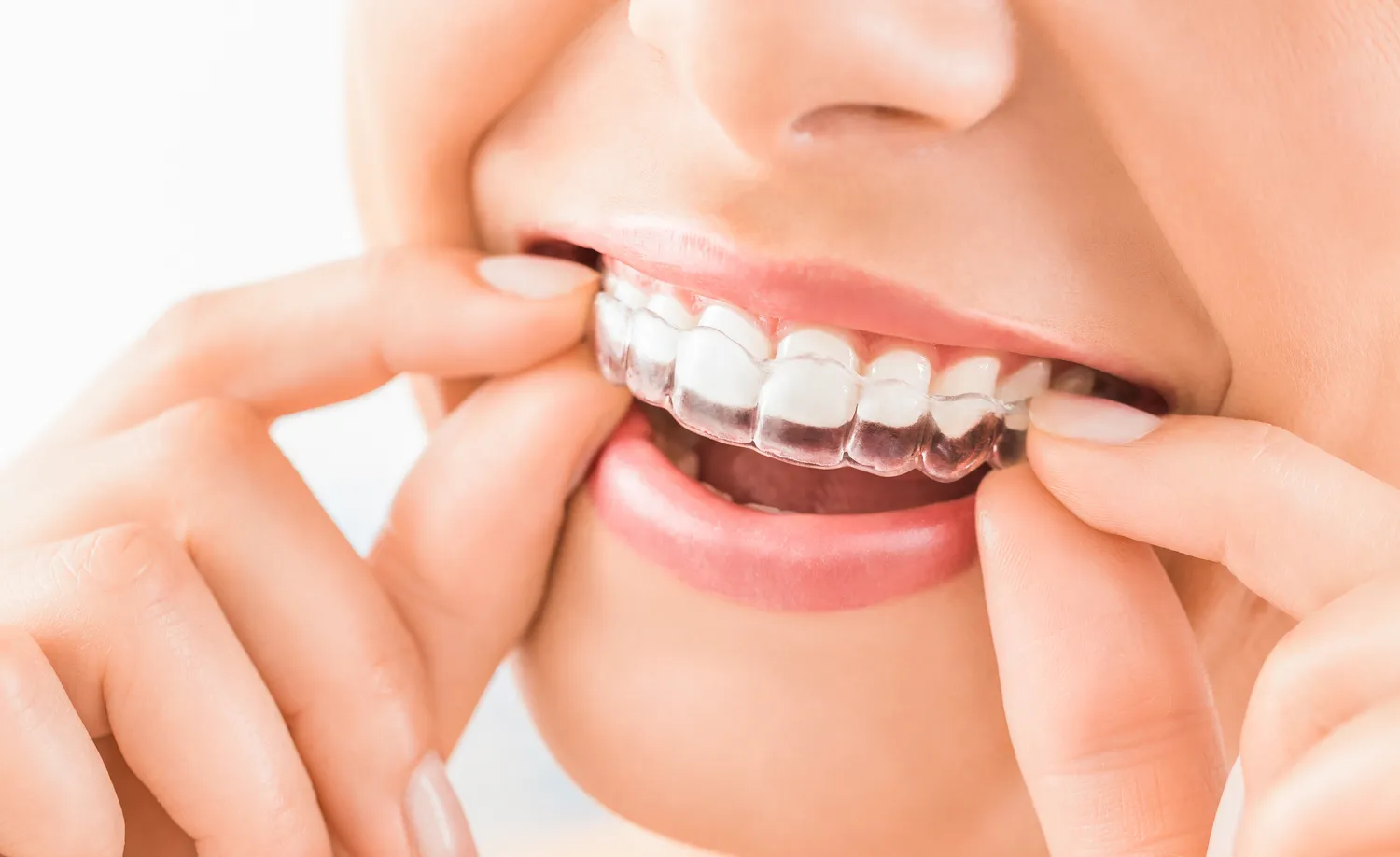 Aparat Invisalign Lublin